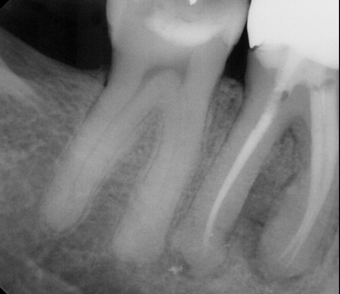 pre-op radiograph