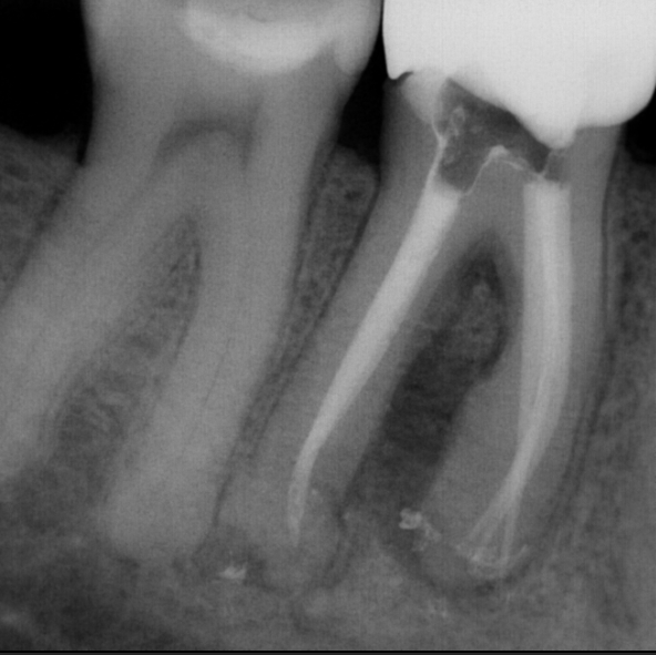 post-op radiograph