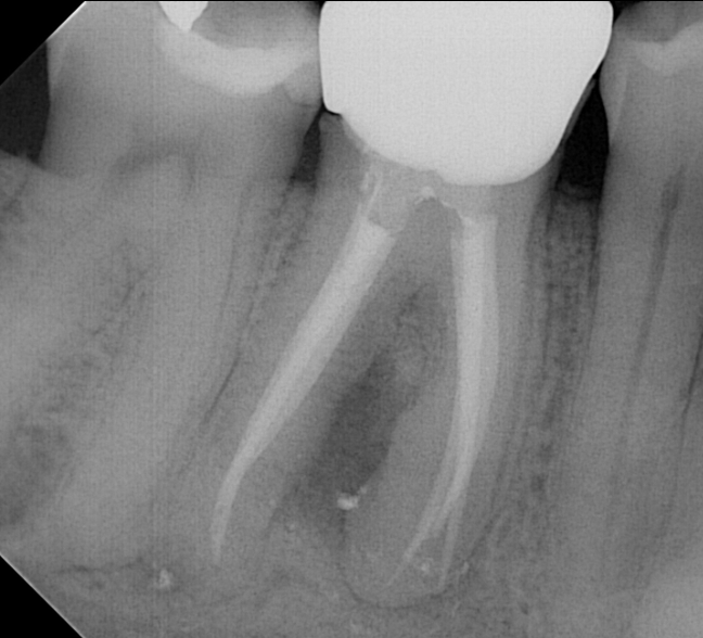 follow-up radiograph