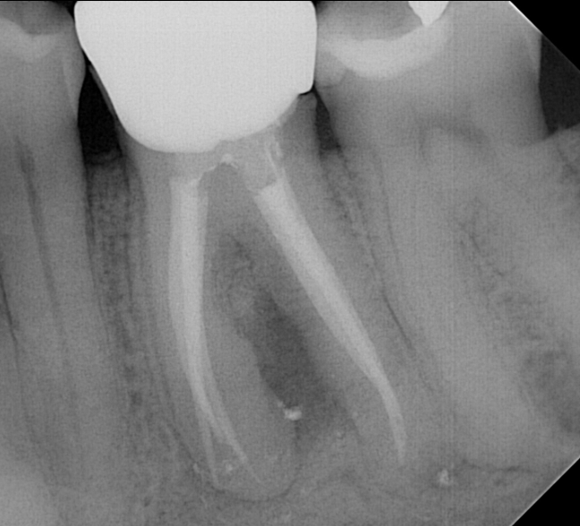 Retreatment of Mandibular Molar (#19) with Large PARL​