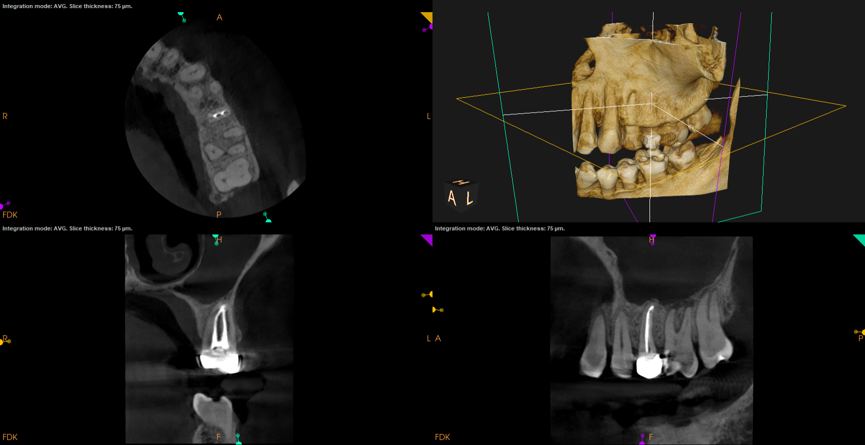 post-op radiograph