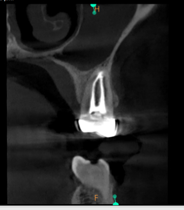 post-op radiograph