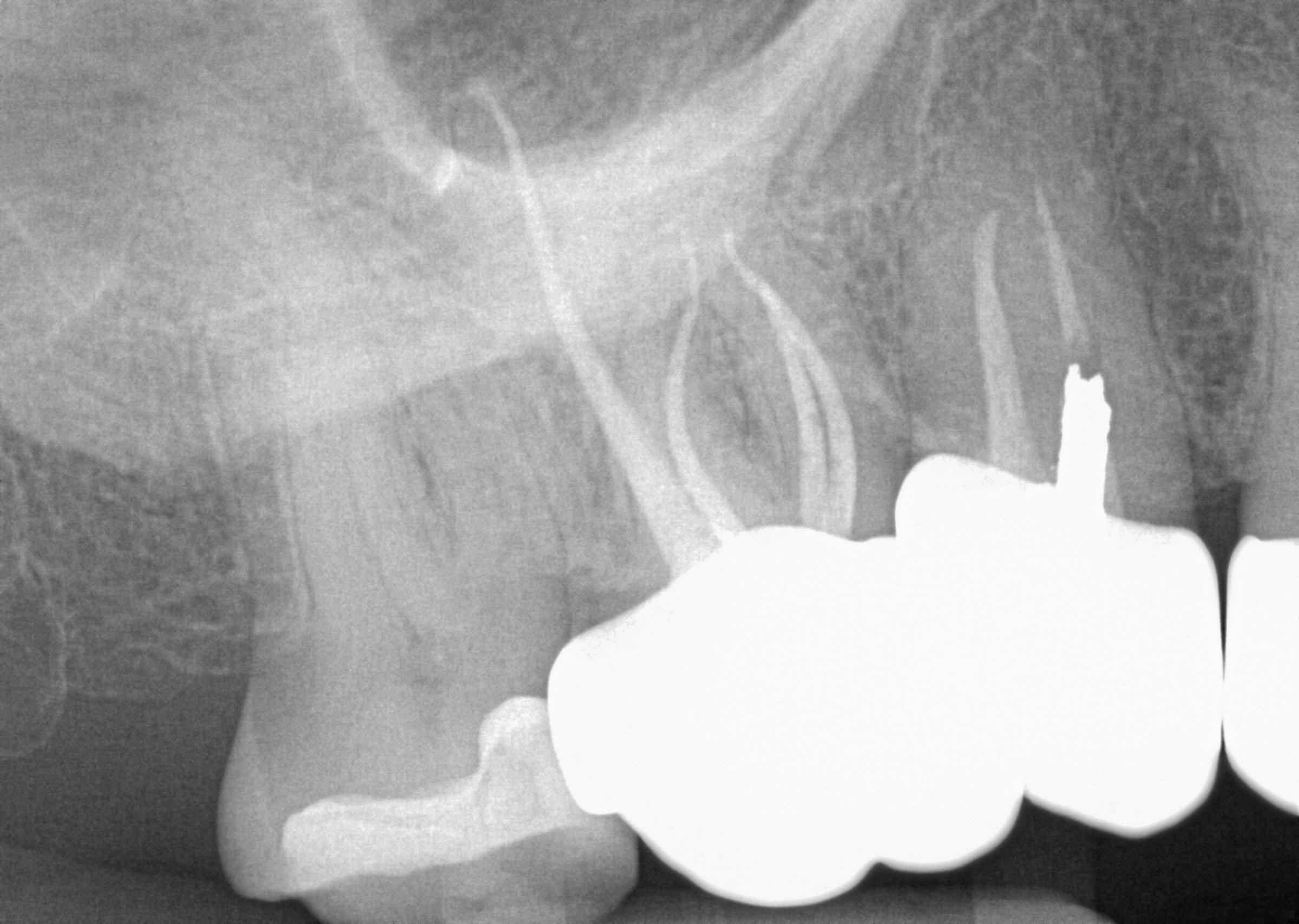 follow-up radiograph