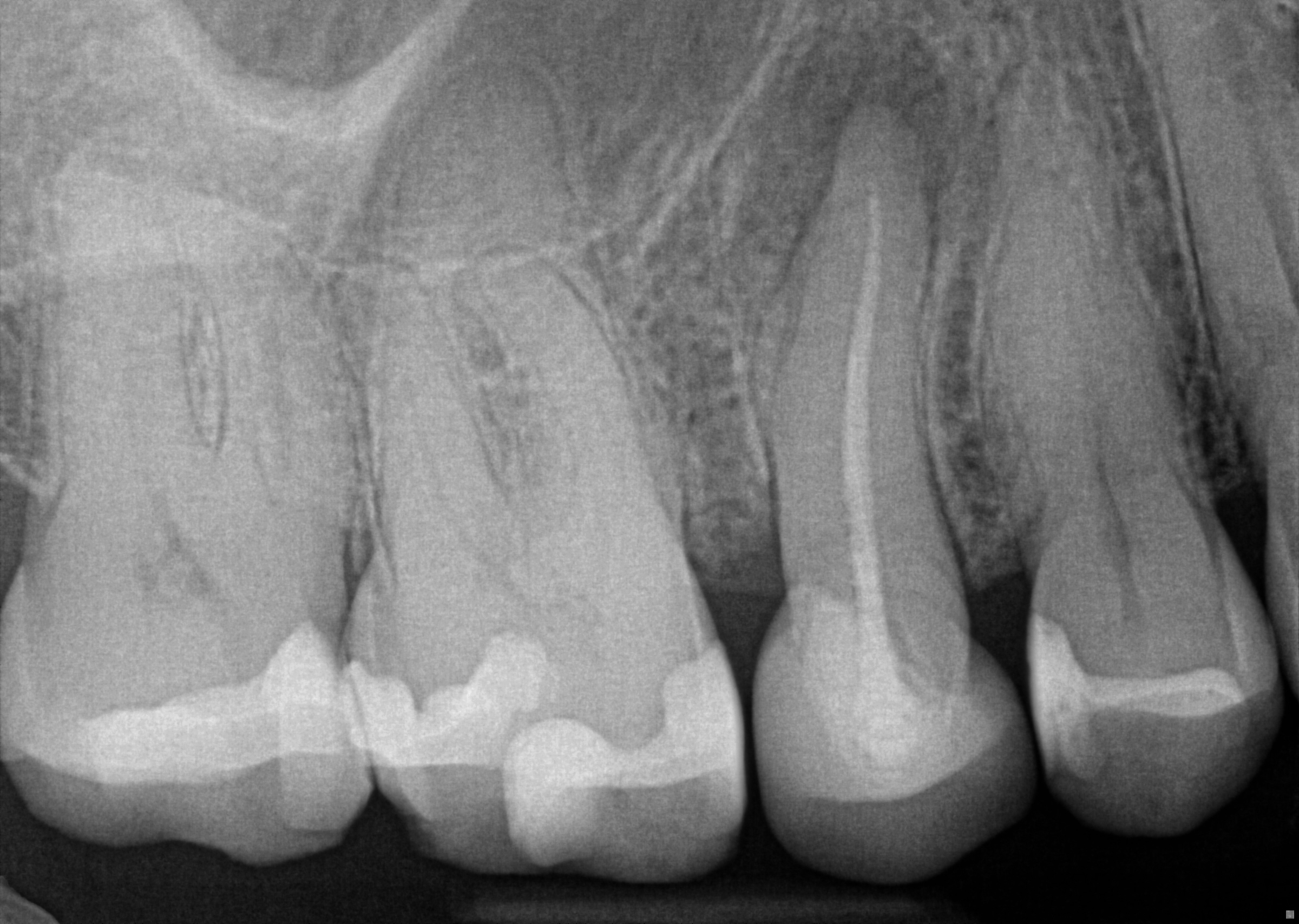 pre-op radiograph
