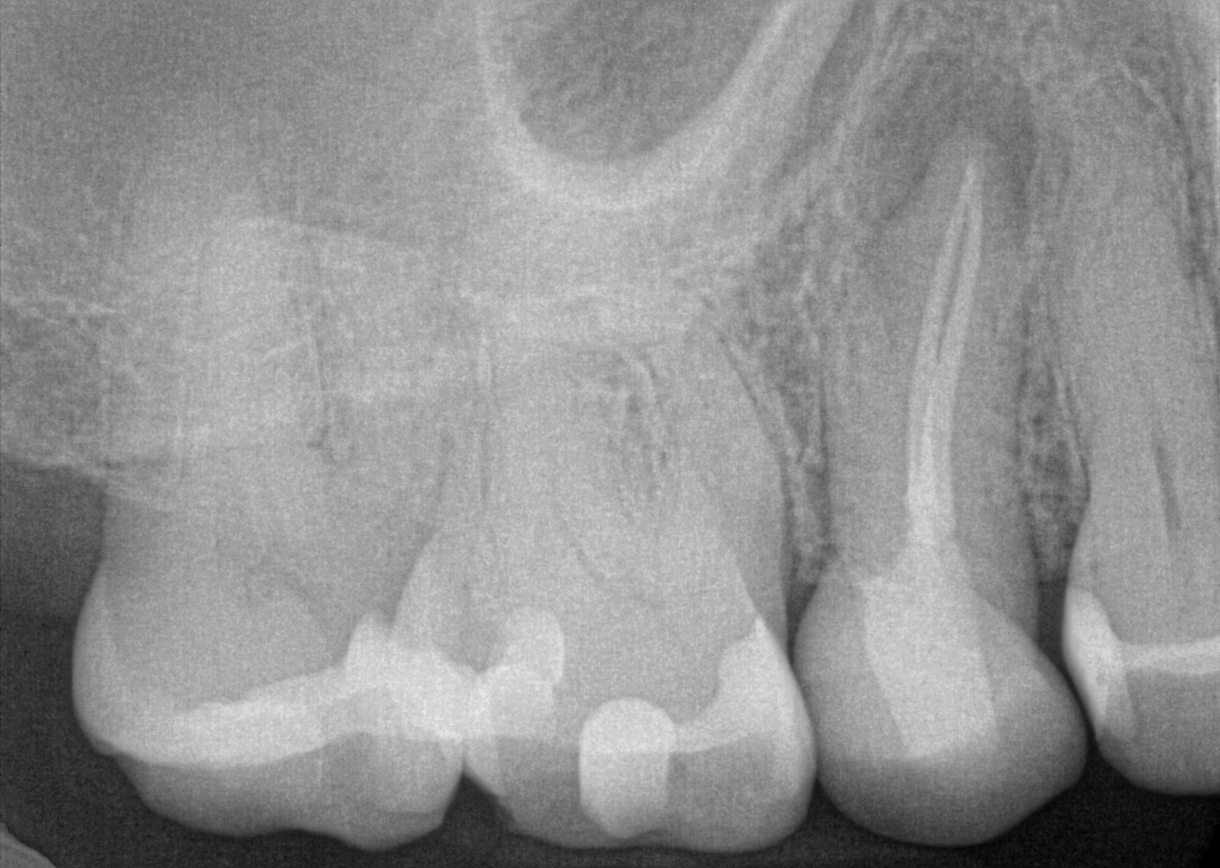 post-op radiograph