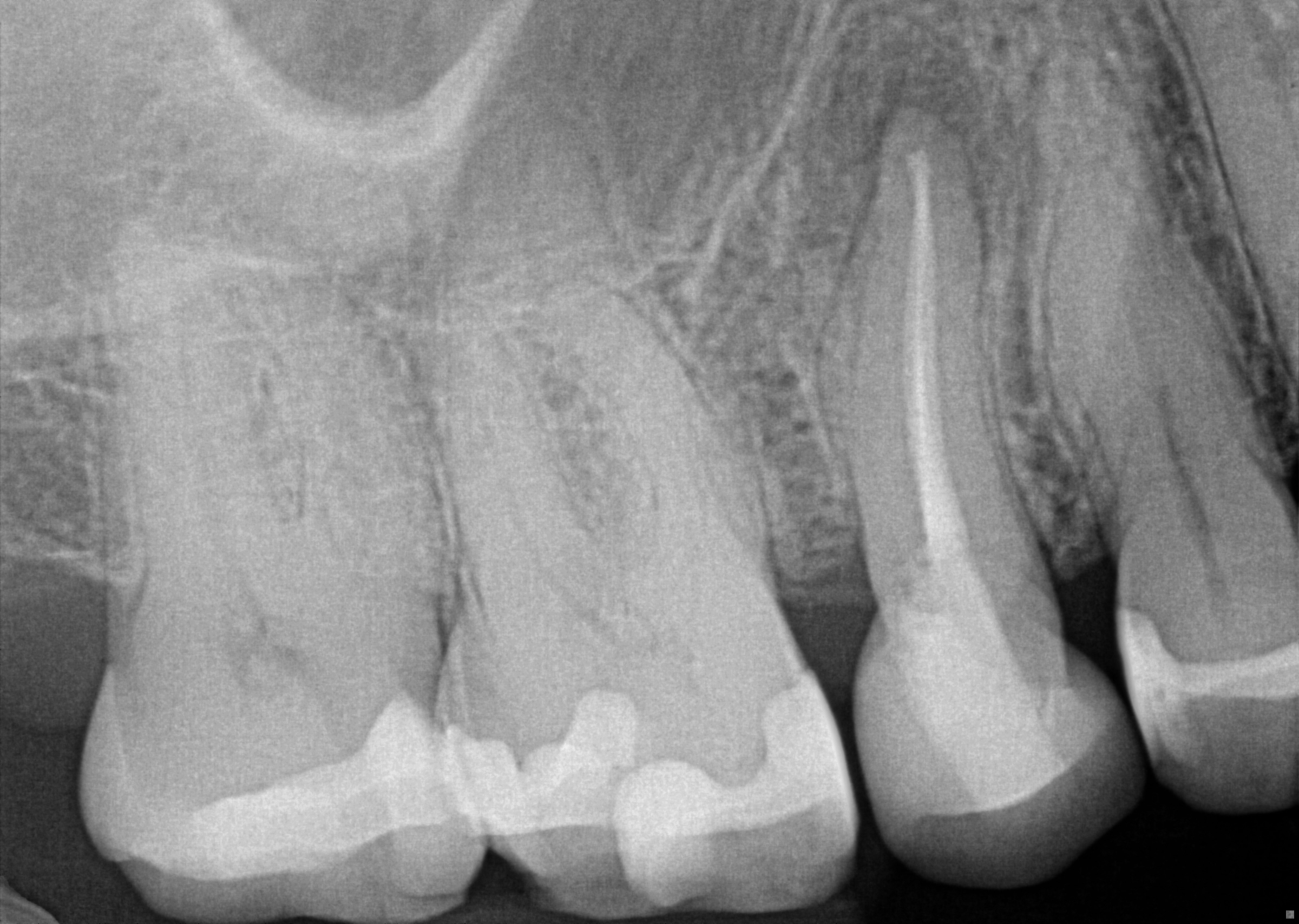 Non-Surgical Retreatment of Previously Treated Premolar​