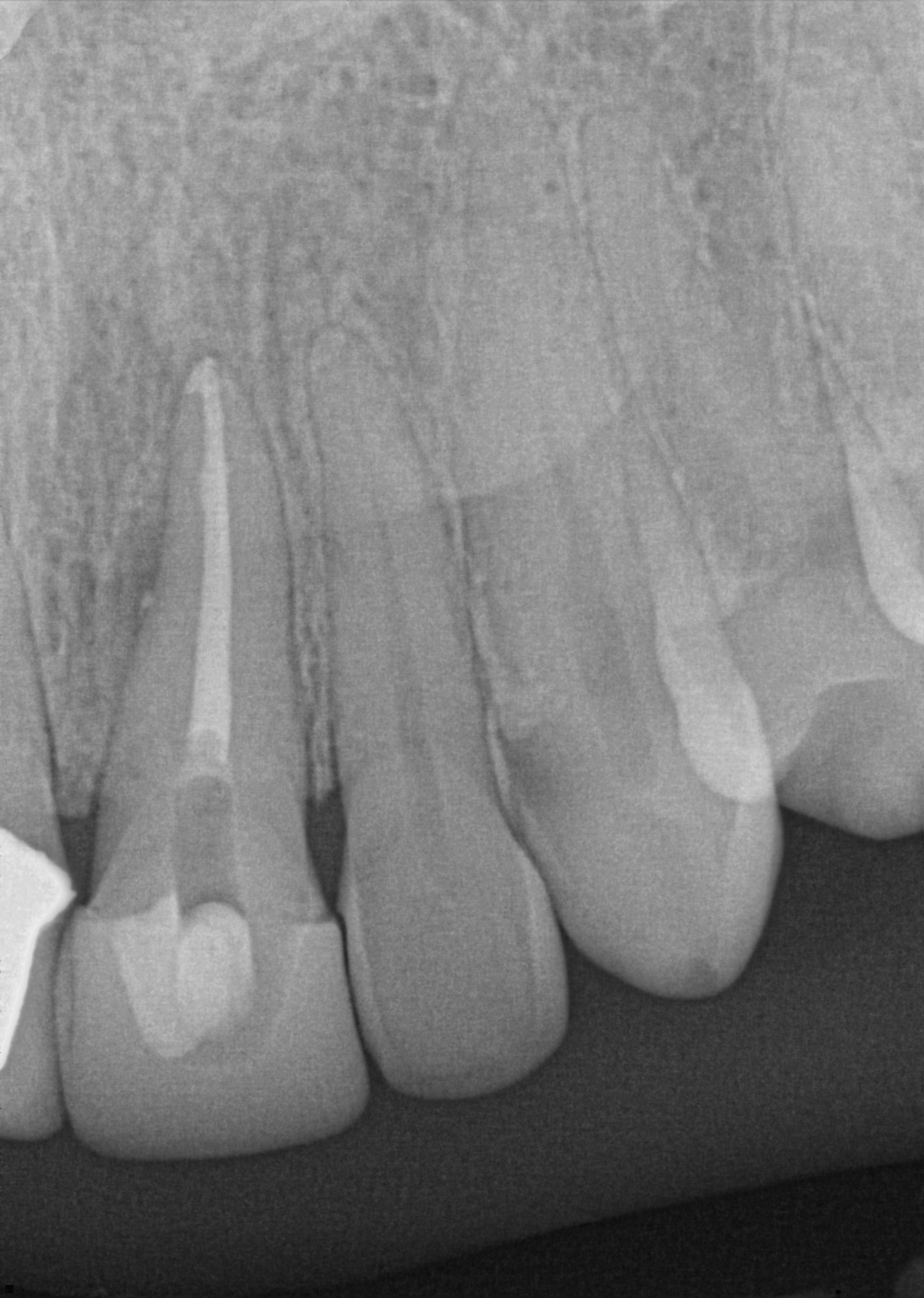 post-op radiograph