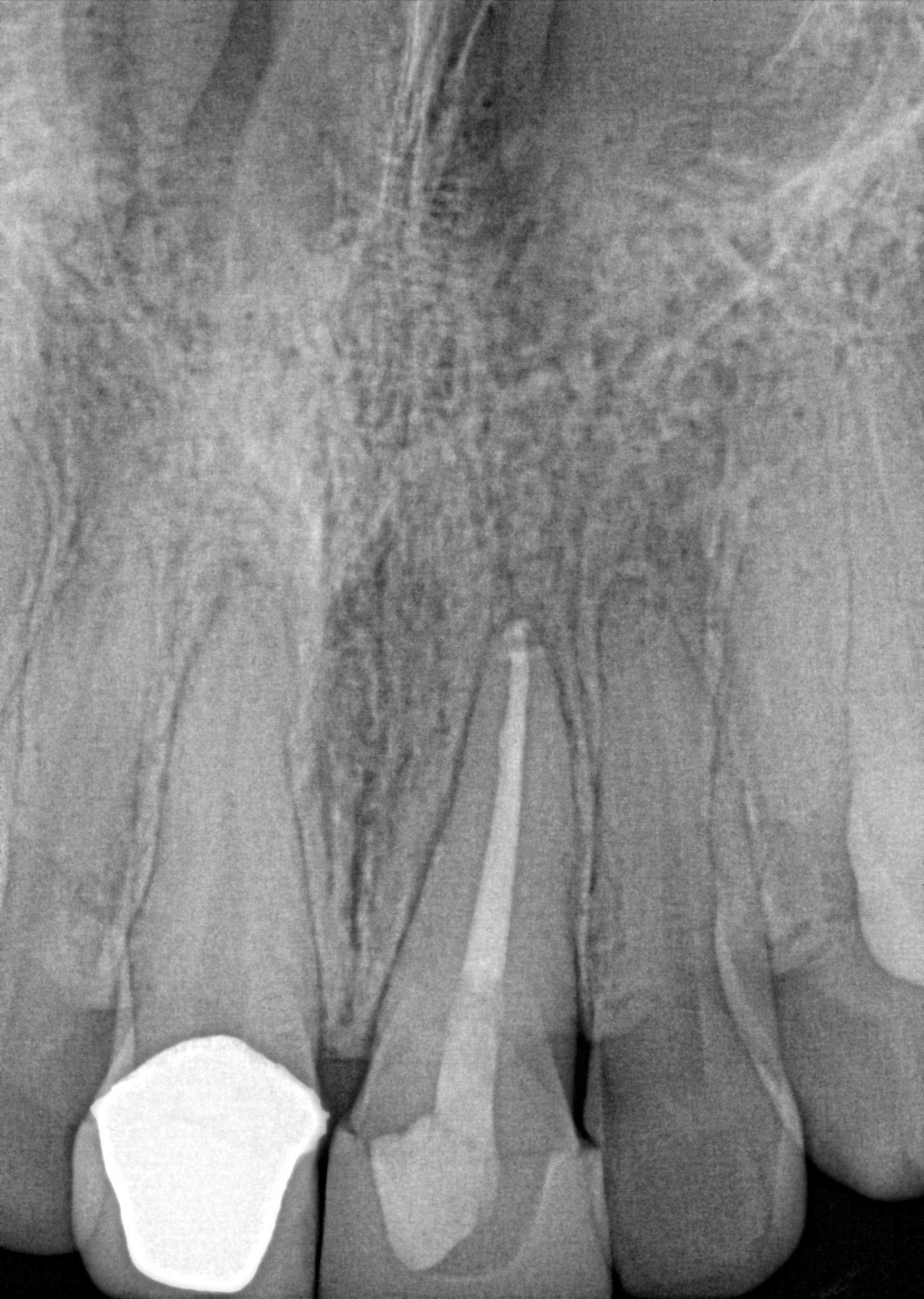 follow-up radiograph