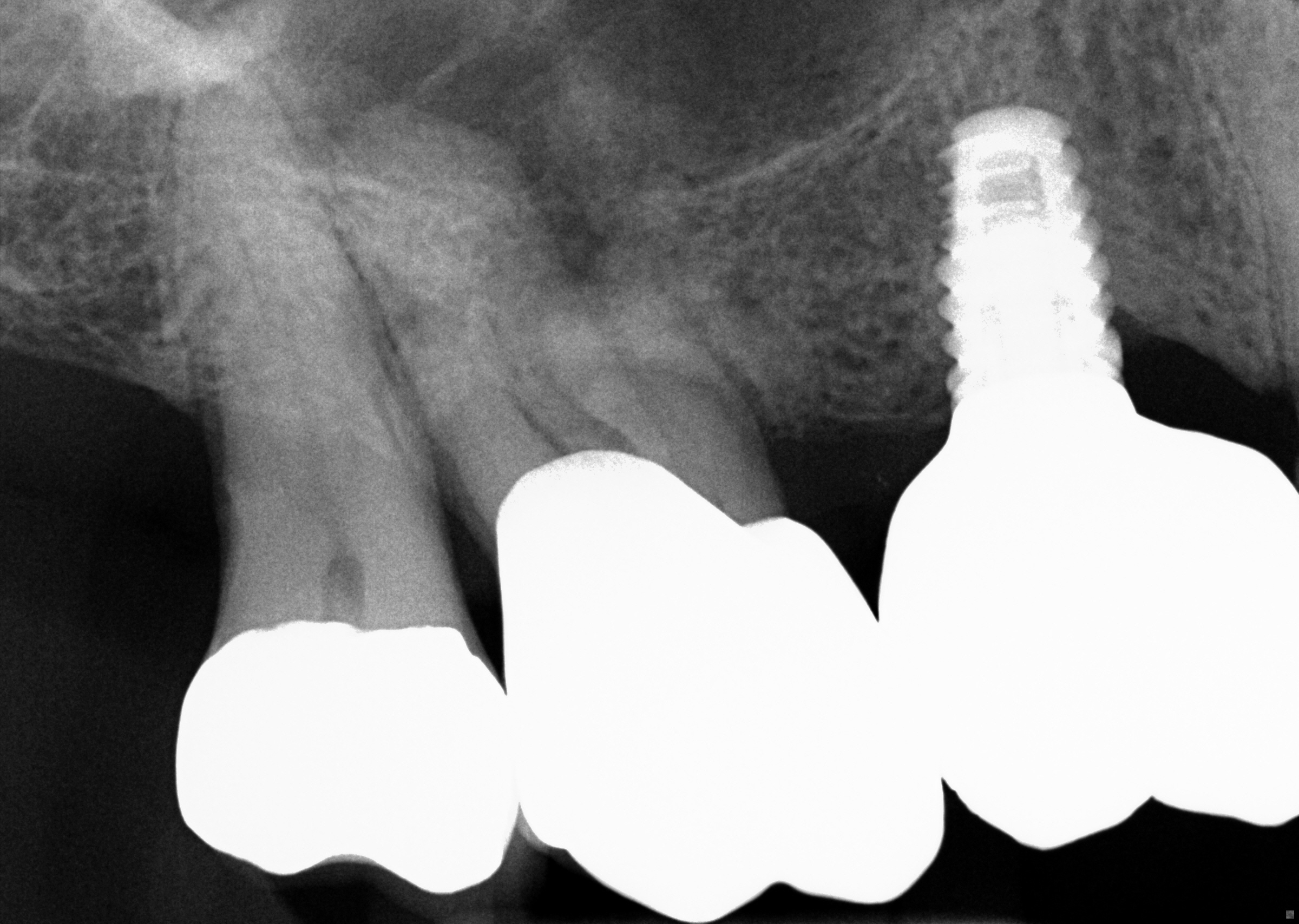 pre-op radiograph