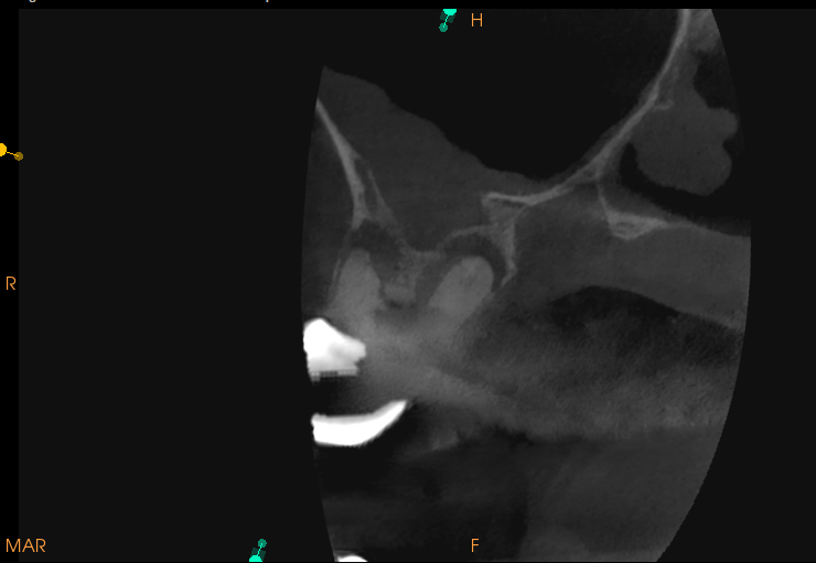 pre-op scan