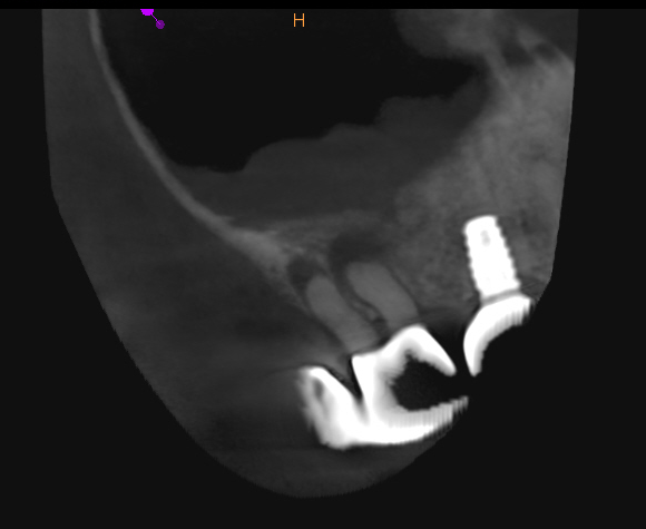 pre-op scan