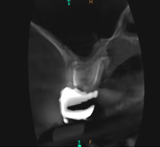follow-up scan