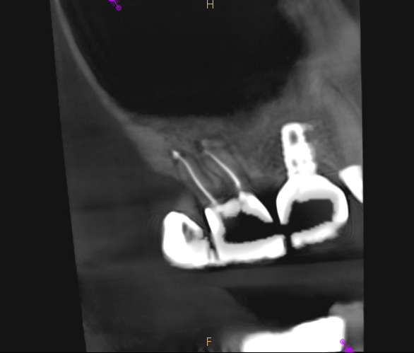 Management of Extensive Periapical Lesion​
