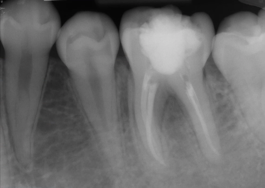 pre-op radiograph