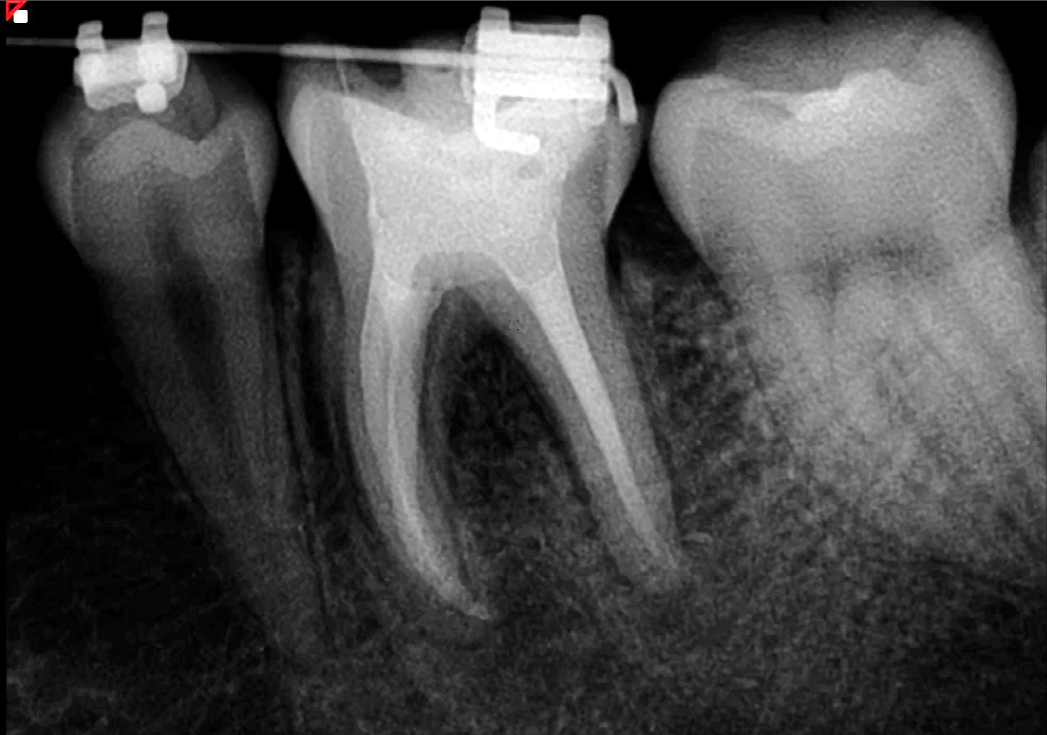 post-op radiograph
