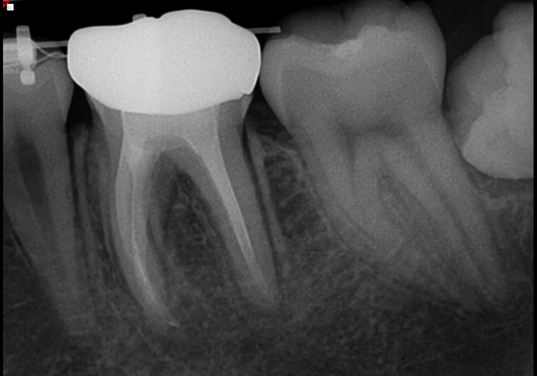 follow-up radiograph