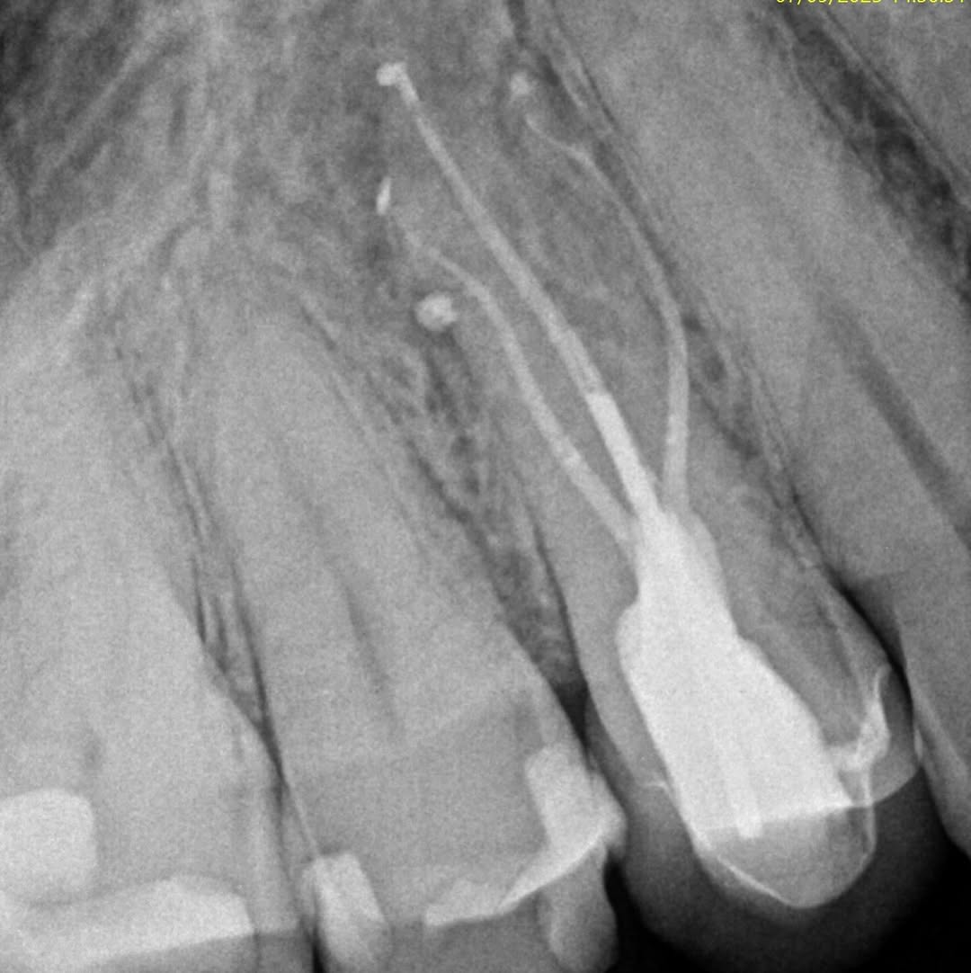 post-op radiograph